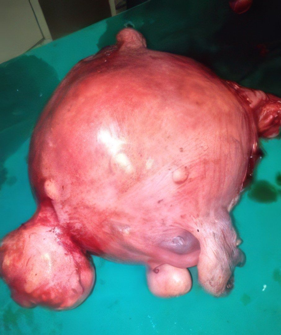 A mass removed during a complex operation by Dr. Khyati S. Daru