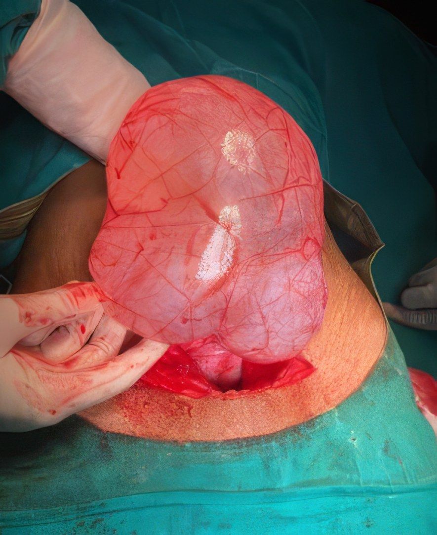 A large cyst brought out during an operation by Dr. Khyati S. Daru