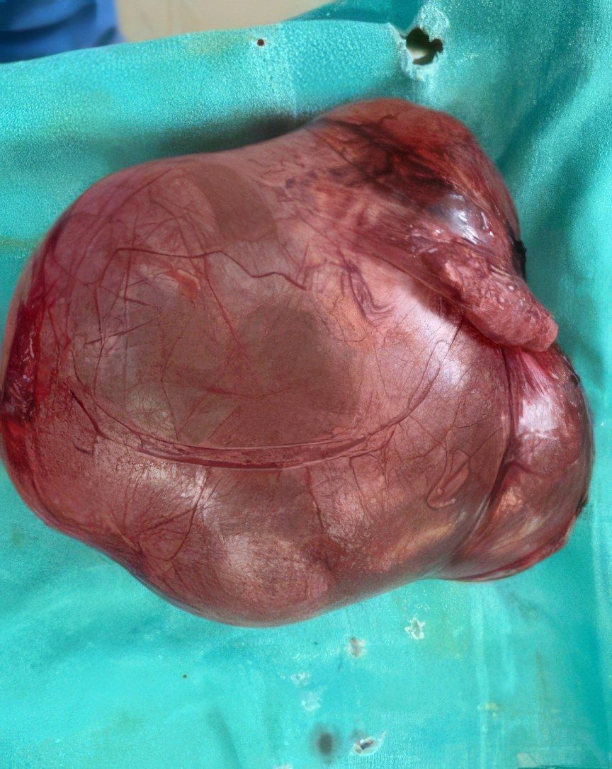A large mass removed during a complex operation by Dr. Khyati S. Daru