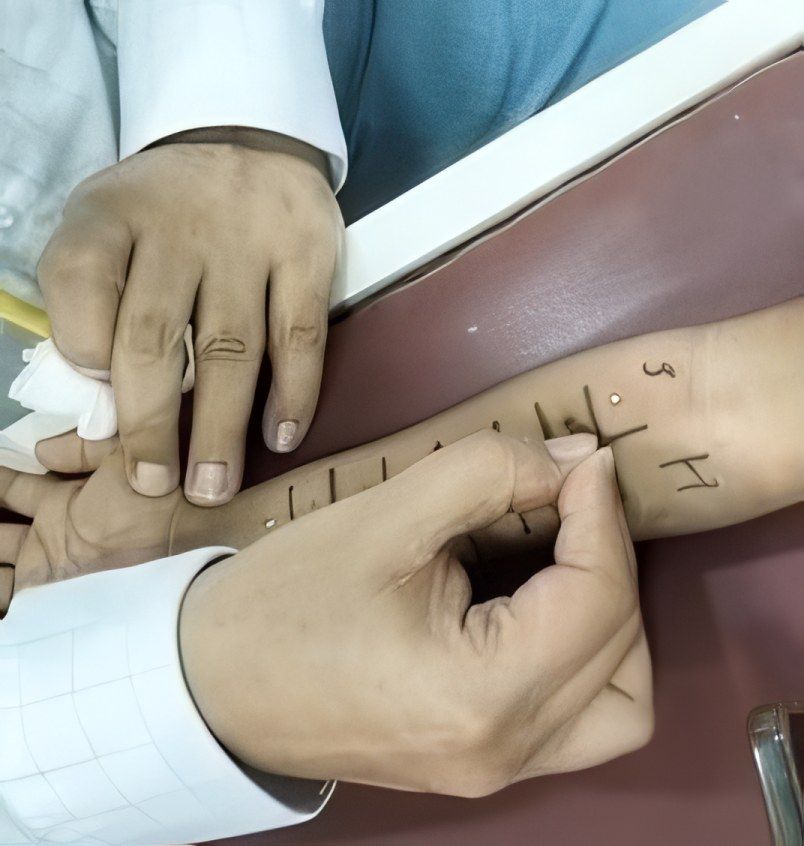 A light prick through a drop of allergen on the marked forearm