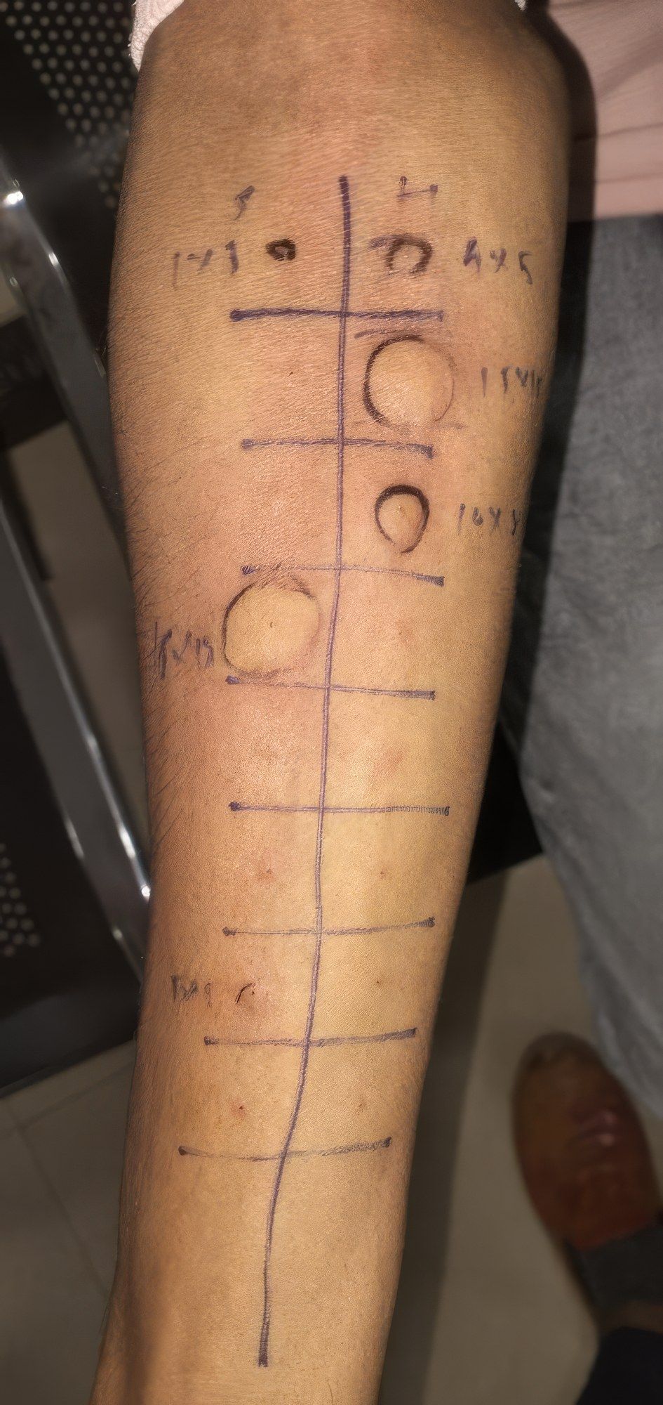 A skin prick test after 20 minutes: each reaction is circled and measured
